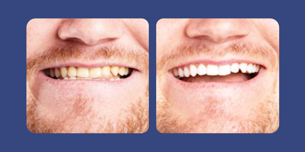 teeth before and after whitening